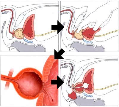 Esquema da prostatectomia aberta (técnica de Millin)